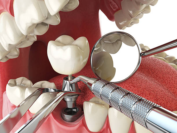 Best Emergency Tooth Extraction in Dunlap, OH